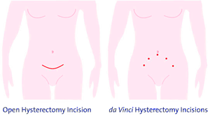 A robotic hysterectomy only requires several small incisions instead of the traditional single, long incision
